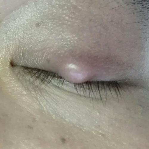 爹爹右眼睑长出小“鹌鹑蛋”,原是患上睑板腺癌