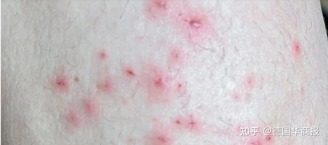 德国出现首例猴痘病毒新变种